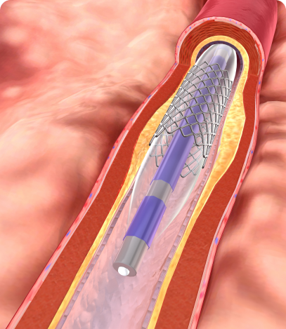 Angioplasty & Stenting