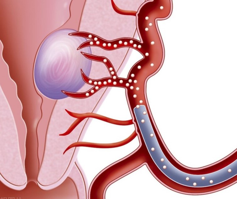 Fibroid Embolization