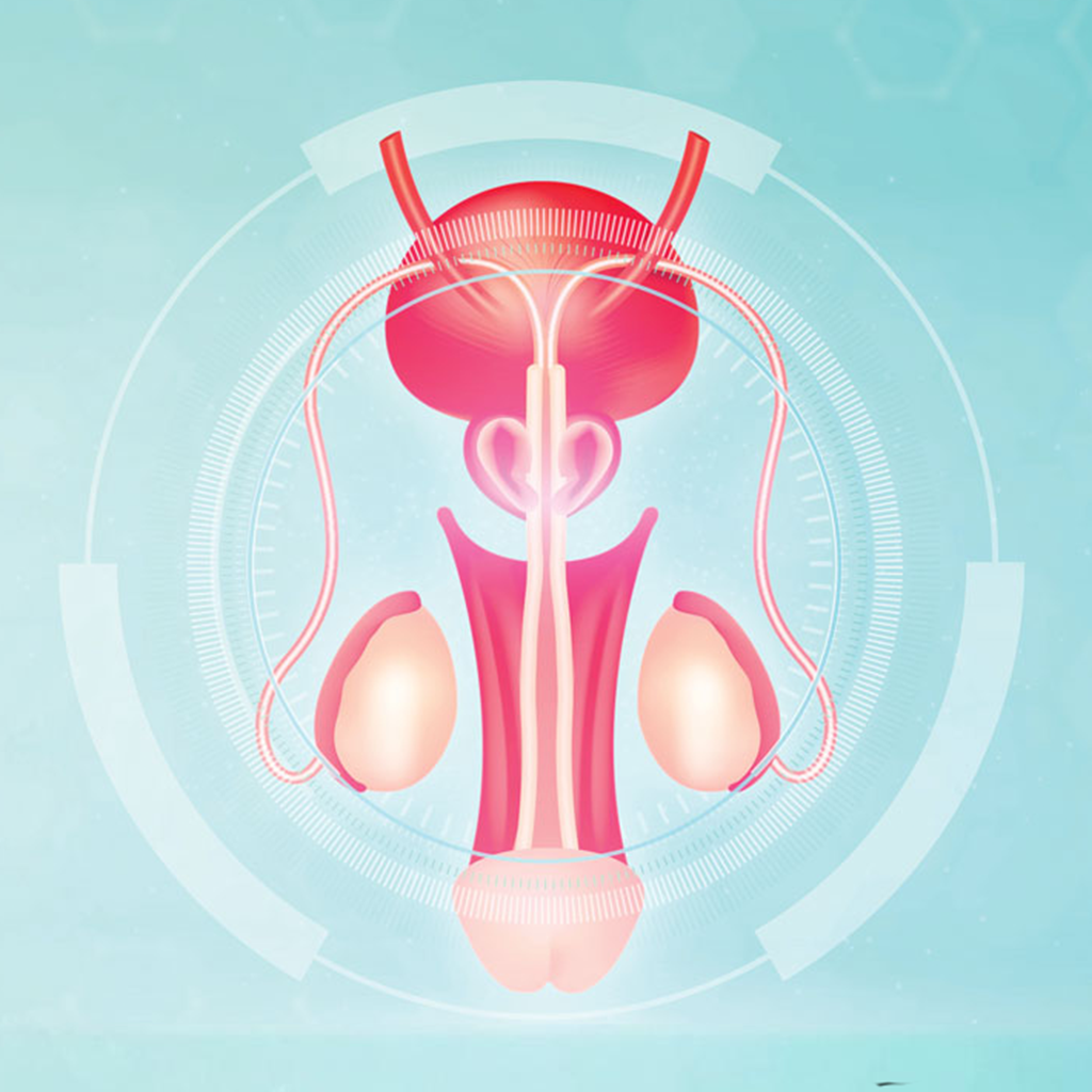 Varicocele Embolization
