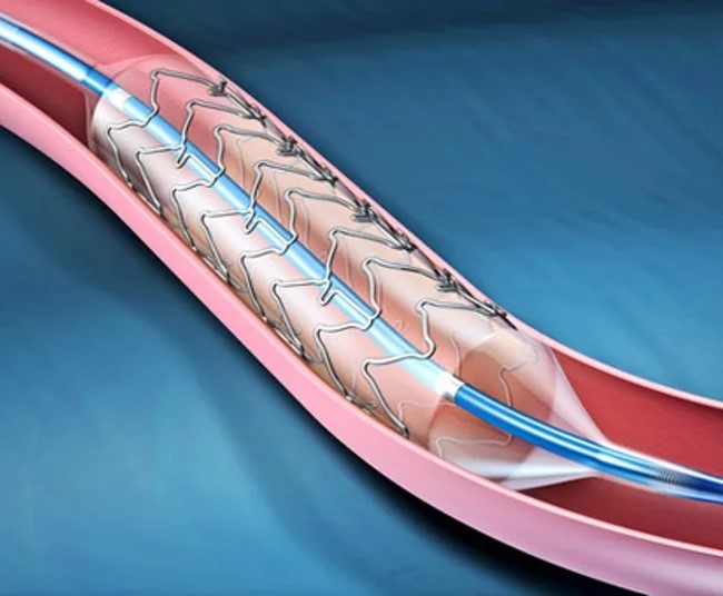 Angiography vs Angioplasty