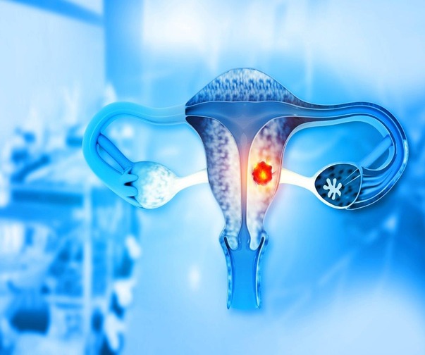 Uterine Fibroid Embolization vs Surgery: