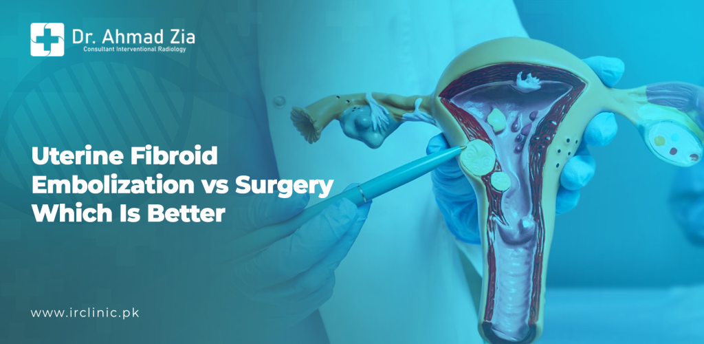 Uterine Fibroid Embolization vs Surgery