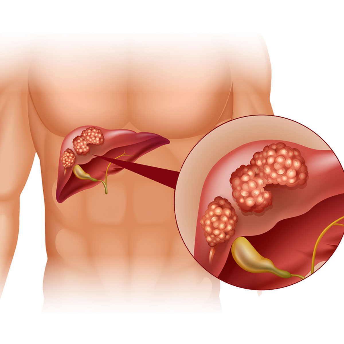 Liver Tumor Treatment