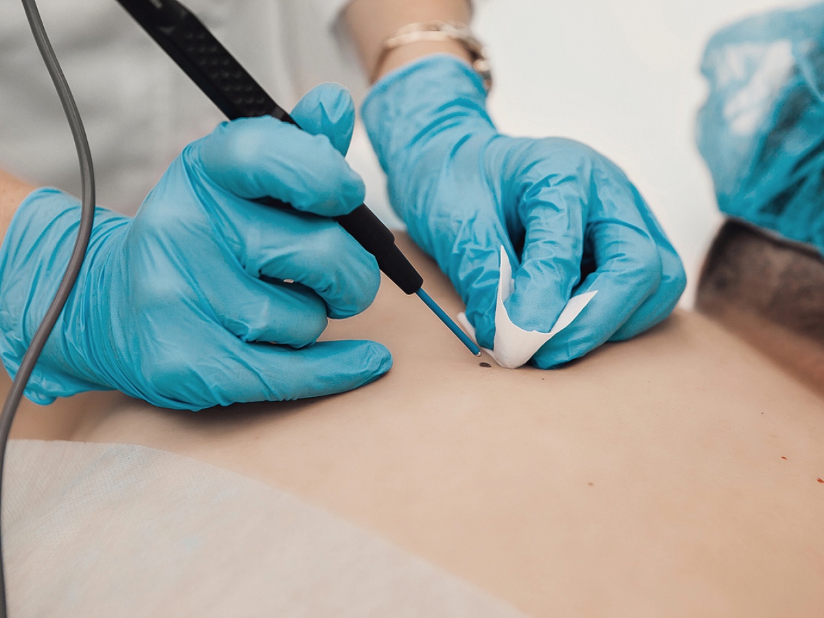 incisional biopsy vs. excisional biopsy