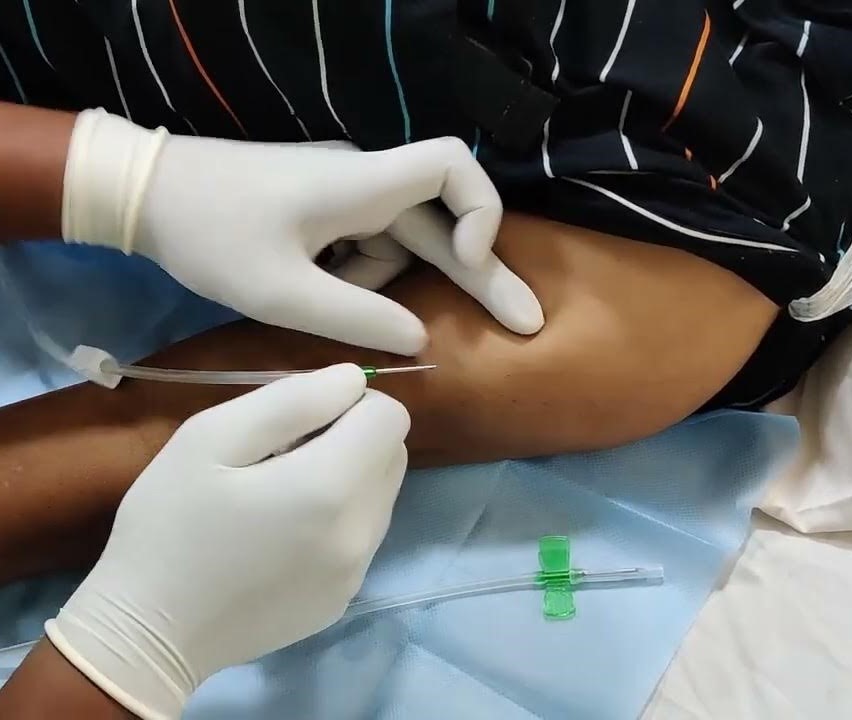 why AV fistula is created for hemodialysis