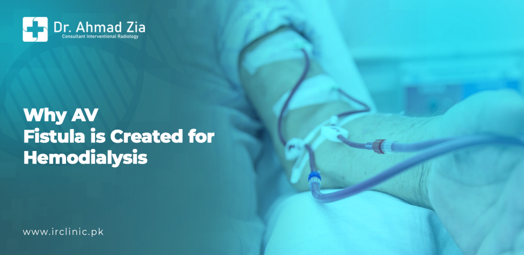 why AV fistula is created for hemodialysis